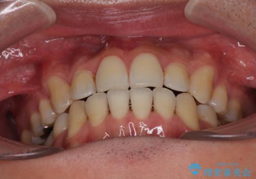 口が閉じにくい原因を根本から改善|上下顎4本抜歯による矯正治療症例の治療後