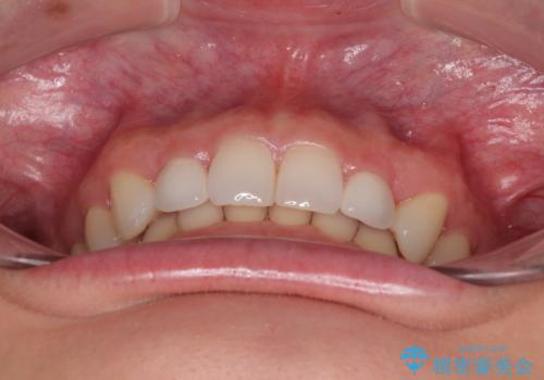 前歯のデコボコと小さい歯を改善 インビザラインとオールセラミッククラウンの治療後