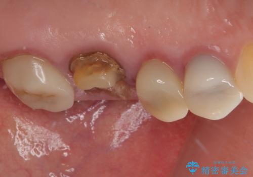 予後不良の奥歯　抜歯即時埋入インプラントによる補綴治療の治療前