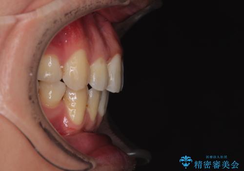 口が閉じにくい原因を根本から改善|上下顎4本抜歯による矯正治療症例の治療後