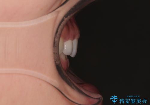 前歯のデコボコと小さい歯を改善　インビザラインとオールセラミッククラウンの治療後