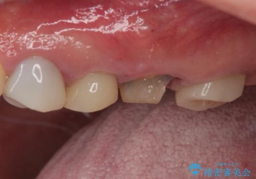 予後不良の奥歯　抜歯即時埋入インプラントによる補綴治療の治療前