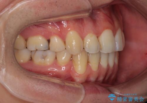 口が閉じにくい原因を根本から改善|上下顎4本抜歯による矯正治療症例の治療後
