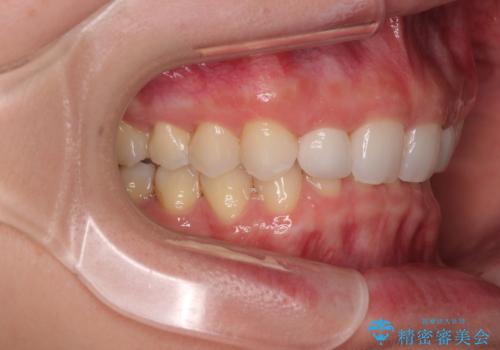 前歯のデコボコと小さい歯を改善 インビザラインとオールセラミッククラウンの治療後