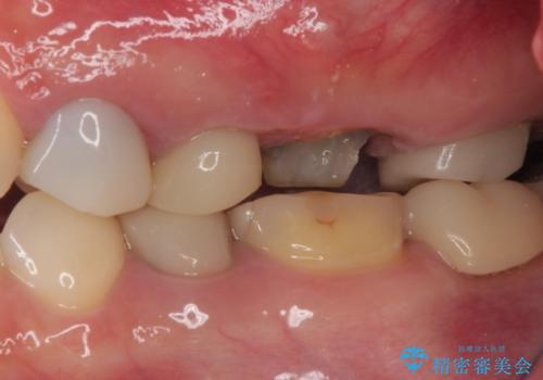 予後不良の奥歯　抜歯即時埋入インプラントによる補綴治療の治療前