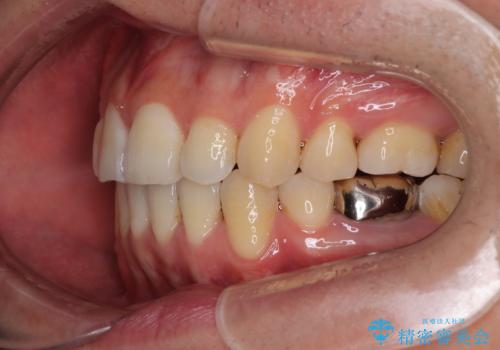 口が閉じにくい原因を根本から改善|上下顎4本抜歯による矯正治療症例の治療後