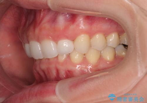 前歯のデコボコと小さい歯を改善 インビザラインとオールセラミッククラウンの治療後