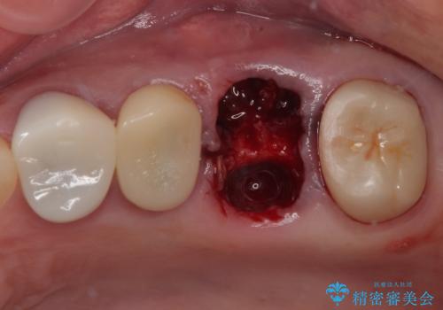 予後不良の奥歯 抜歯即時埋入インプラントによる補綴治療の治療中
