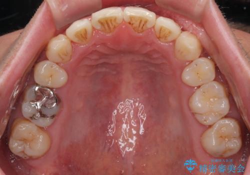 口が閉じにくい原因を根本から改善|上下顎4本抜歯による矯正治療症例の治療後
