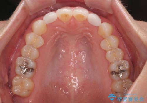 前歯のデコボコと小さい歯を改善　インビザラインとオールセラミッククラウンの治療後