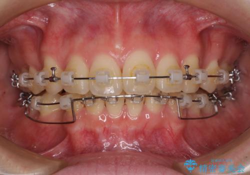 深い咬み合わせと飛び出した前歯　ワイヤー装置での抜歯矯正治療の治療中