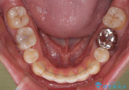 口が閉じにくい原因を根本から改善|上下顎4本抜歯による矯正治療症例の治療後