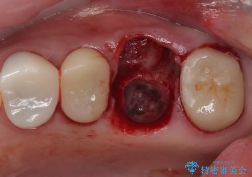 予後不良の奥歯 抜歯即時埋入インプラントによる補綴治療の治療後
