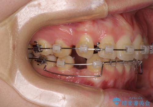 深い咬み合わせと飛び出した前歯 ワイヤー装置での抜歯矯正治療の治療中