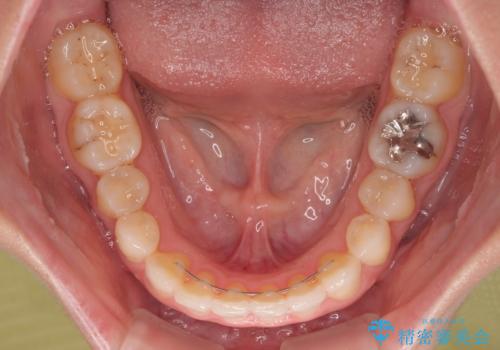 前歯のデコボコと小さい歯を改善　インビザラインとオールセラミッククラウンの治療後