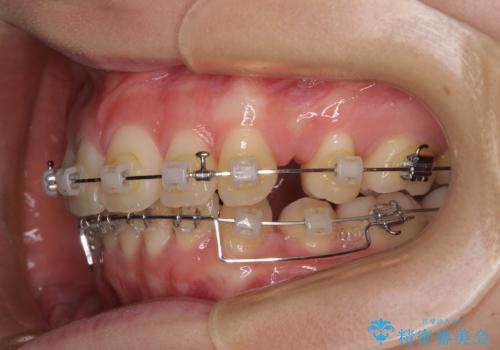 深い咬み合わせと飛び出した前歯　ワイヤー装置での抜歯矯正治療の治療中