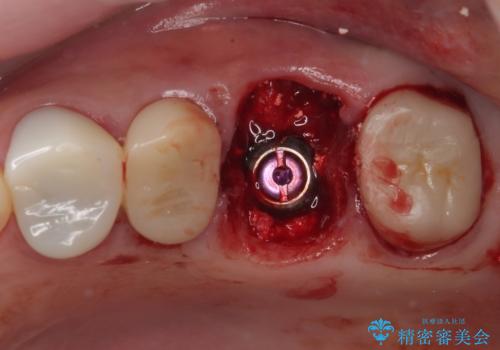 予後不良の奥歯 抜歯即時埋入インプラントによる補綴治療の治療中