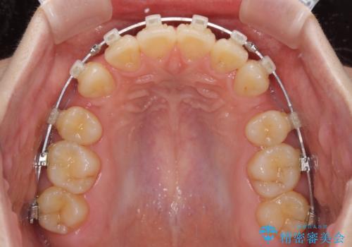 深い咬み合わせと飛び出した前歯　ワイヤー装置での抜歯矯正治療の治療中