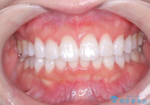 結婚式にむけてのホワイトニング