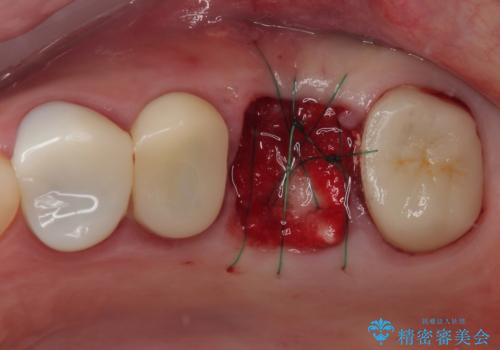 予後不良の奥歯　抜歯即時埋入インプラントによる補綴治療の治療中