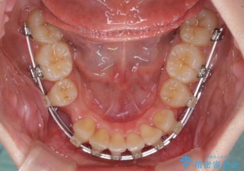 深い咬み合わせと飛び出した前歯　ワイヤー装置での抜歯矯正治療の治療中