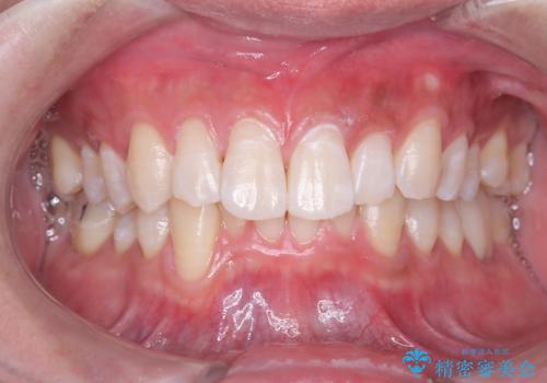 白い歯で清潔感get!初ホワイトニング