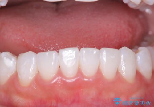 結婚式にむけてのホワイトニングの症例 治療後