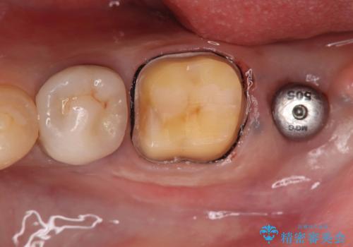 歯根嚢胞と瘻孔を伴う奥歯を抜歯即時インプラントで治療|一回の手術で改善!|インプラントの治療期間3か月の治療中