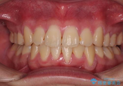 全体的なデコボコをスッキリと　ワイヤー装置での抜歯矯正の治療後