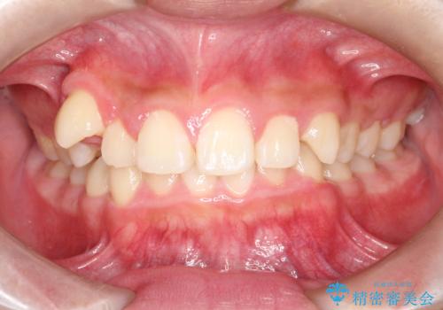 八重歯・歯並びのデコボコとディープバイトを改善した抜歯ワイヤー矯正症例