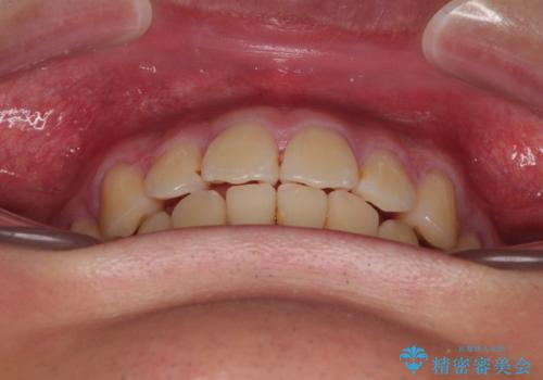 全体的なデコボコをスッキリと ワイヤー装置での抜歯矯正の治療後