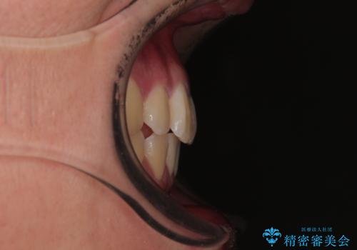 全体的なデコボコをスッキリと ワイヤー装置での抜歯矯正の治療後