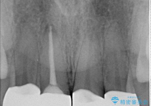 【オールセラミッククラウン】歯の色を合わせたいの治療後