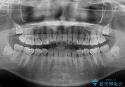捻れて前に出ている前歯 ワイヤー装置での非抜歯矯正の治療前