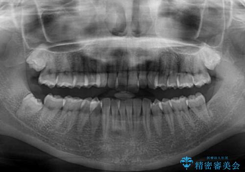 前歯が隠れるほどのデコボコをインビザライン矯正できれいに整えるの治療前
