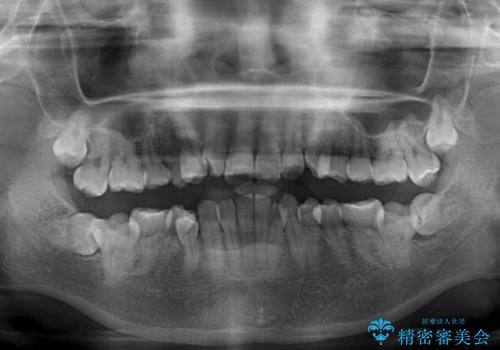 デコボコだらけの歯列をきれいに ワイヤー装置での抜歯矯正治療の治療前