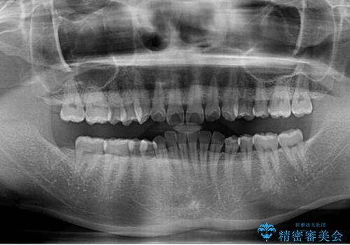 隠れた前歯が気になる　ディープバイトのワイヤー矯正治療の治療前