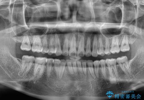隠れた前歯が気になる ディープバイトのワイヤー矯正治療の治療後