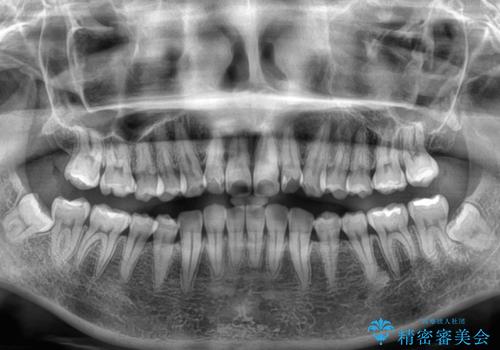 デコボコと咬み合わせを改善 インビザライン矯正治療の治療前