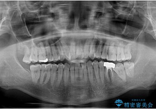 口が閉じにくい原因を根本から改善|上下顎4本抜歯による矯正治療症例の治療前
