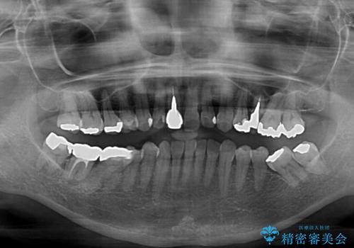 むし歯治療とインビザライン矯正治療 総合歯科治療で整った口腔内にの治療前
