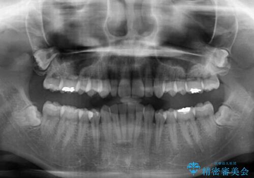 前歯のデコボコと小さい歯を改善 インビザラインとオールセラミッククラウンの治療前