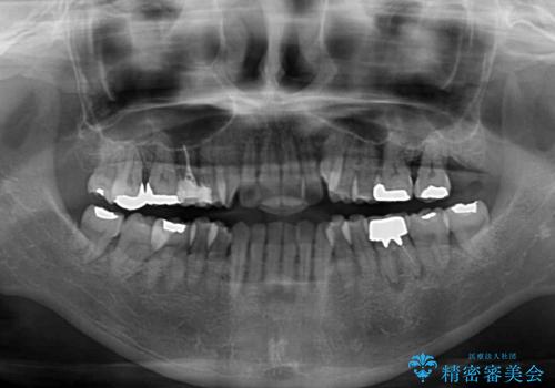 受け口と八重歯を改善　インビザライン矯正治療の治療前