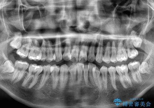 全体的なデコボコをスッキリと ワイヤー装置での抜歯矯正の治療前