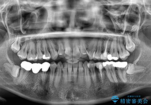 【モニター】前歯のデコボコをインビザラインで綺麗にの治療前