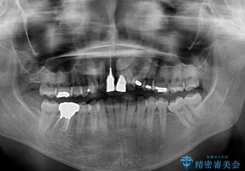前歯のデコボコをワイヤー矯正で綺麗に 保険診療の前歯クラウンもセラミッククラウンで自然にの治療前
