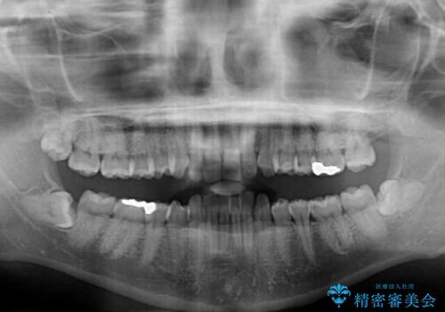 抜歯矯正で口が閉じやすく|ディープバイトと叢生を改善した症例の治療前