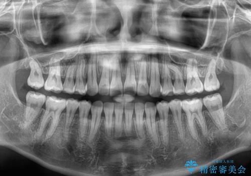 捻れて前に出ている前歯 ワイヤー装置での非抜歯矯正の治療後