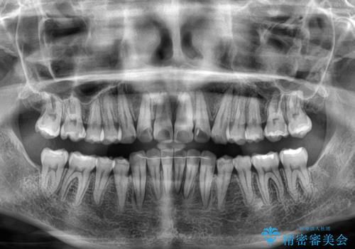 デコボコと咬み合わせを改善　インビザライン矯正治療の治療後