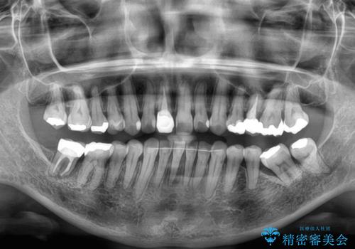 むし歯治療とインビザライン矯正治療 総合歯科治療で整った口腔内にの治療後
